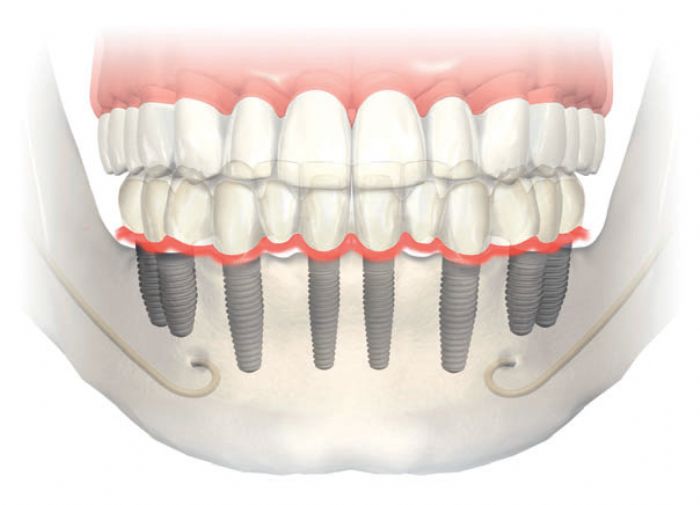 Accesorios para implantes, etc...